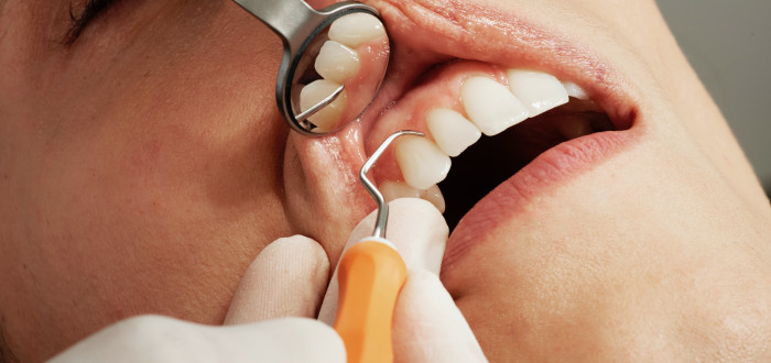 Používání zubní nitě až příliš často nebo s přílišnou intenzitou může vyústit v onemocnění dásní