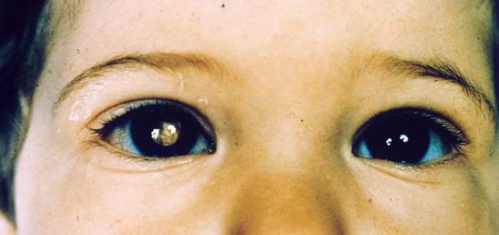 Retinoblastom - rakovina oka, která se objevuje hlavně u dětí 