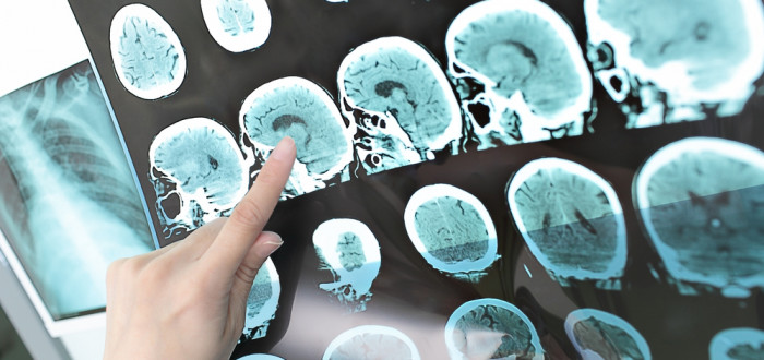 Roztroušená skleróza napadá bílou hmotu mozku, ve které dochází k nervovým vzruchům ze smyslů a ke svalům