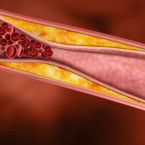 Prevencí proti ateroskleróze je nejlépe pohyb a vyvážená strava