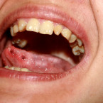 V řadě příznaků je parodontóza podobná parodontitidě, v klinickém nálezu však chybí zánět