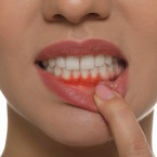 Jedním z nejčastějších příznaků paradontózy je krvácení dásní