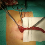 Foto: Operace apendixu