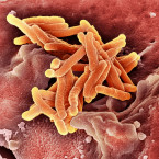 Tuberkulóza většinou napadá plíce, ale může postihnout i jiné části těla. Šíří se vzduchem