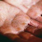 Dokonce i mírná suchost kůže nebo velmi malé praskliny na pokožce mohou být jedním ze symptomů cukrovky