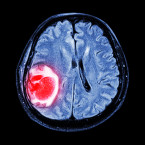 Neobvyklé bolesti hlavy, které se zhoršují hlavně po probuzení, jsou jedním z hlavních příznaků nádoru