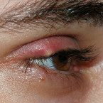 Ječné zrno vzniká ucpáním mazové žlázky na okraji horního či dolního očního víčka