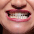 S bělením zubů vám pomůže mimo jiné i zředěný jablečný ocet