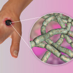 Antrax je vysoce infekční a přenáší se alimentární cestou, kůží přes oděrky nebo skrze dýchací soustavu