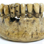 První zmínky o pokusu opravit zub najdeme 9 tisíc let př. n. l. 