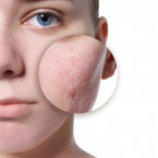 Acne vulgaris (česky trudovitost, případně trudovina), běžně nazývané akné, je jedno z nejčastějších chronických onemocnění kůže