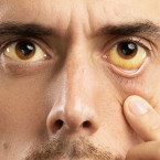 Nažloutlé oči jsou známkou problémů s játry