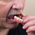 Žluté skvrny na zubech mohou vést až k prasklinám zubů nebo k tvorbě kazu