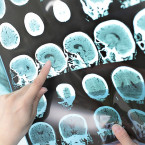 Roztroušená skleróza napadá bílou hmotu mozku, ve které dochází k nervovým vzruchům ze smyslů a ke svalům